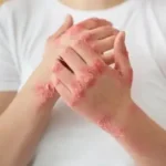 Crecen los casos de sífilis en jóvenes de Misiones y alertan por la baja percepción del riesgo sexual vVaFEGFFA8_480x320__original